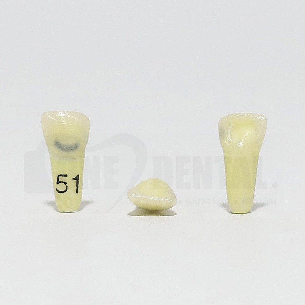 Caries Tooth 51 Cerv & Distal for 1974 Paedo Model
