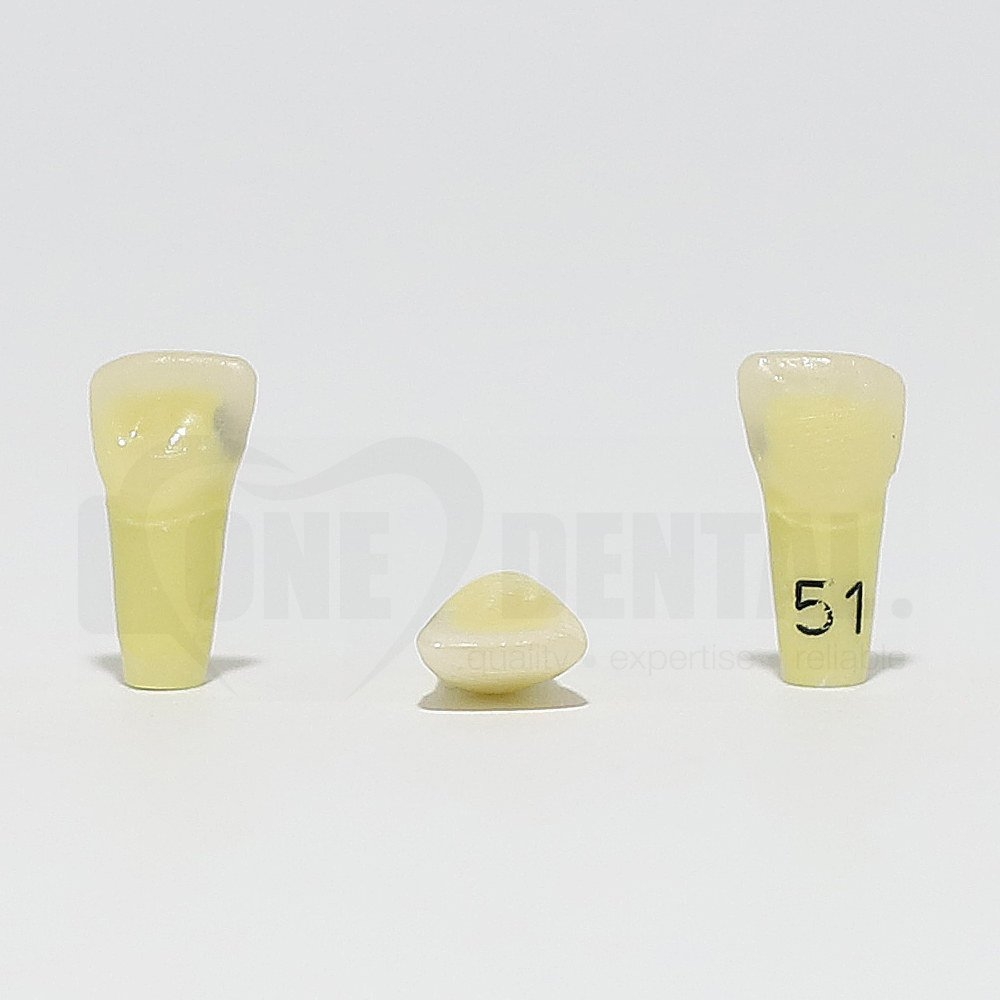 Caries Tooth 51 Mesial for 1974 Paedo Model