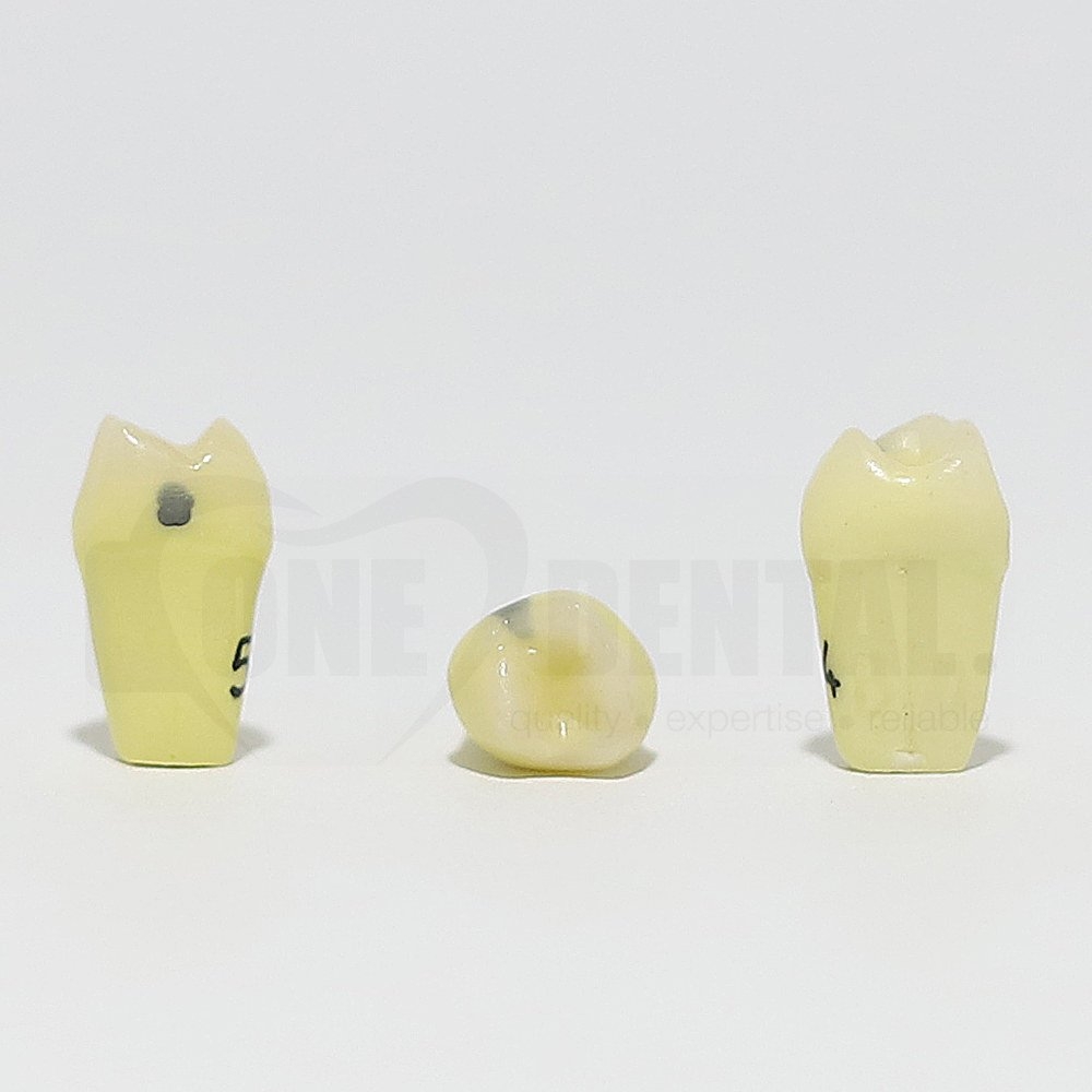 Caries Tooth 54 Distal for 1974 Paedo Model