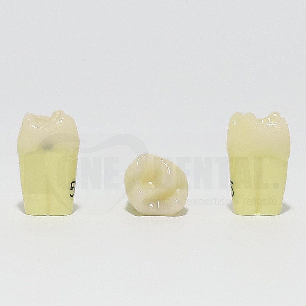 Caries Tooth 55 Distal for 1974 Paedo Model