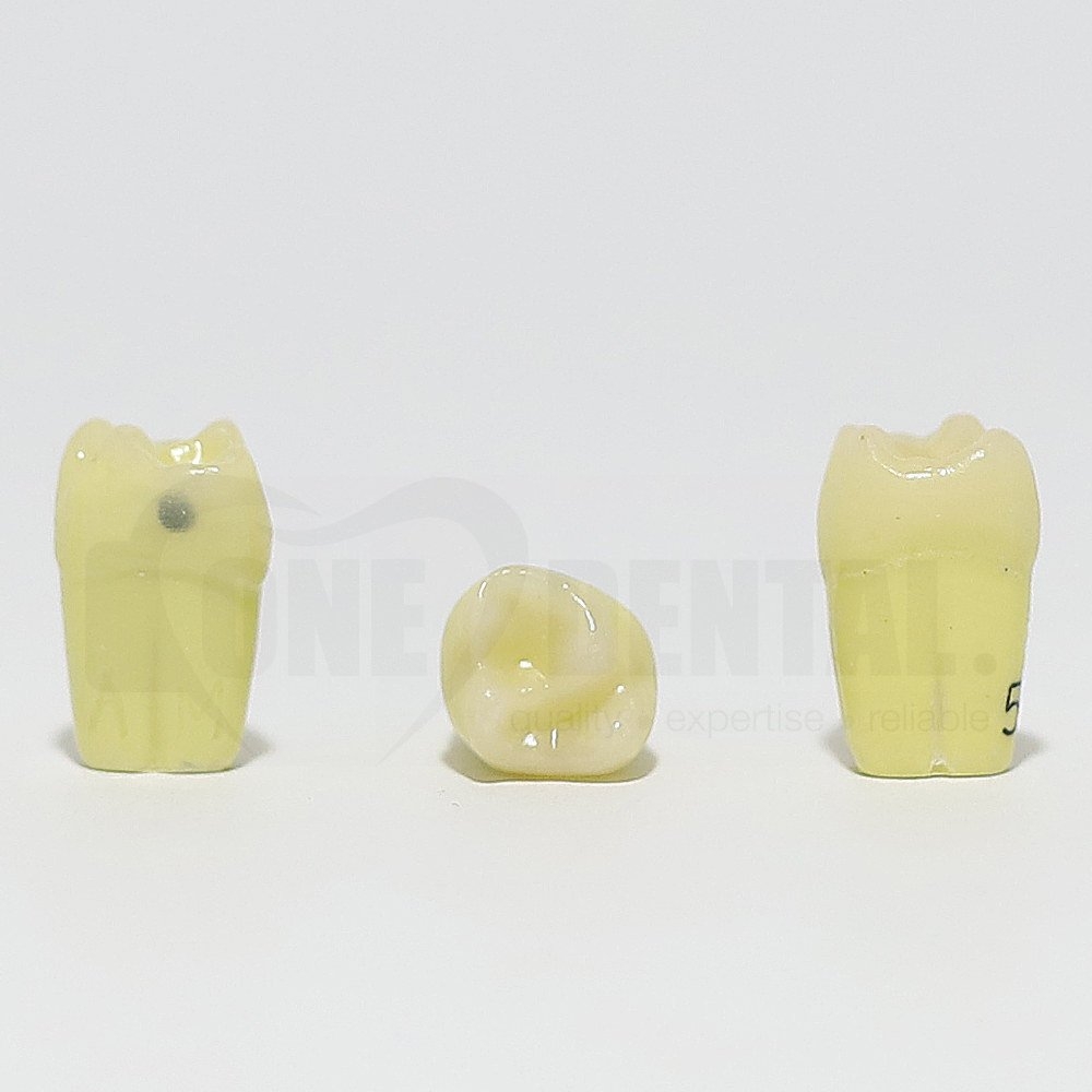 Caries Tooth 55 Mesial for 1974 Paedo Model