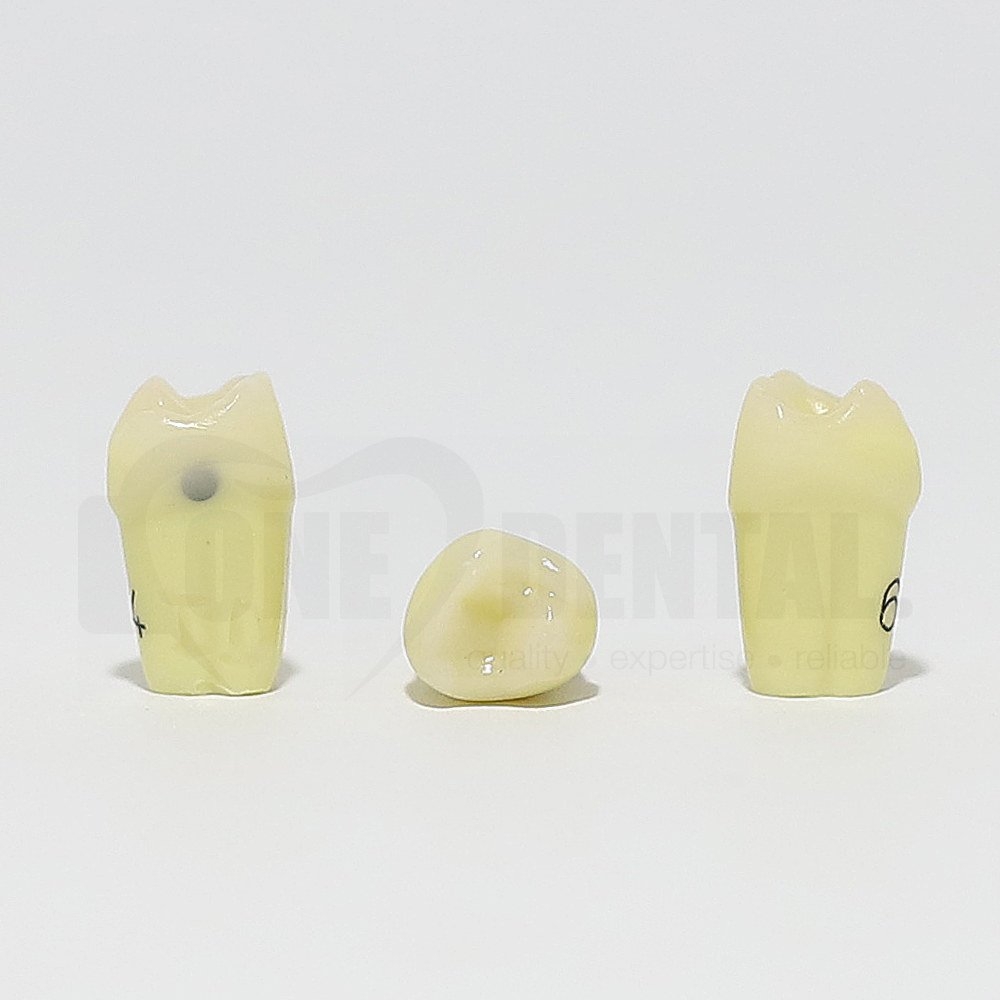 Caries Tooth 64 Distal for 1974 Paedo Model