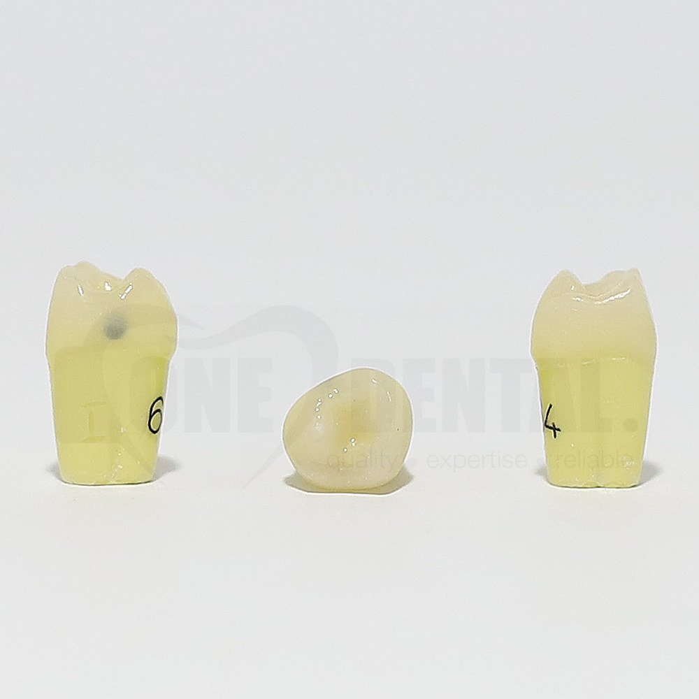 Caries Tooth 64 Mesial for 1974 Paedo Model
