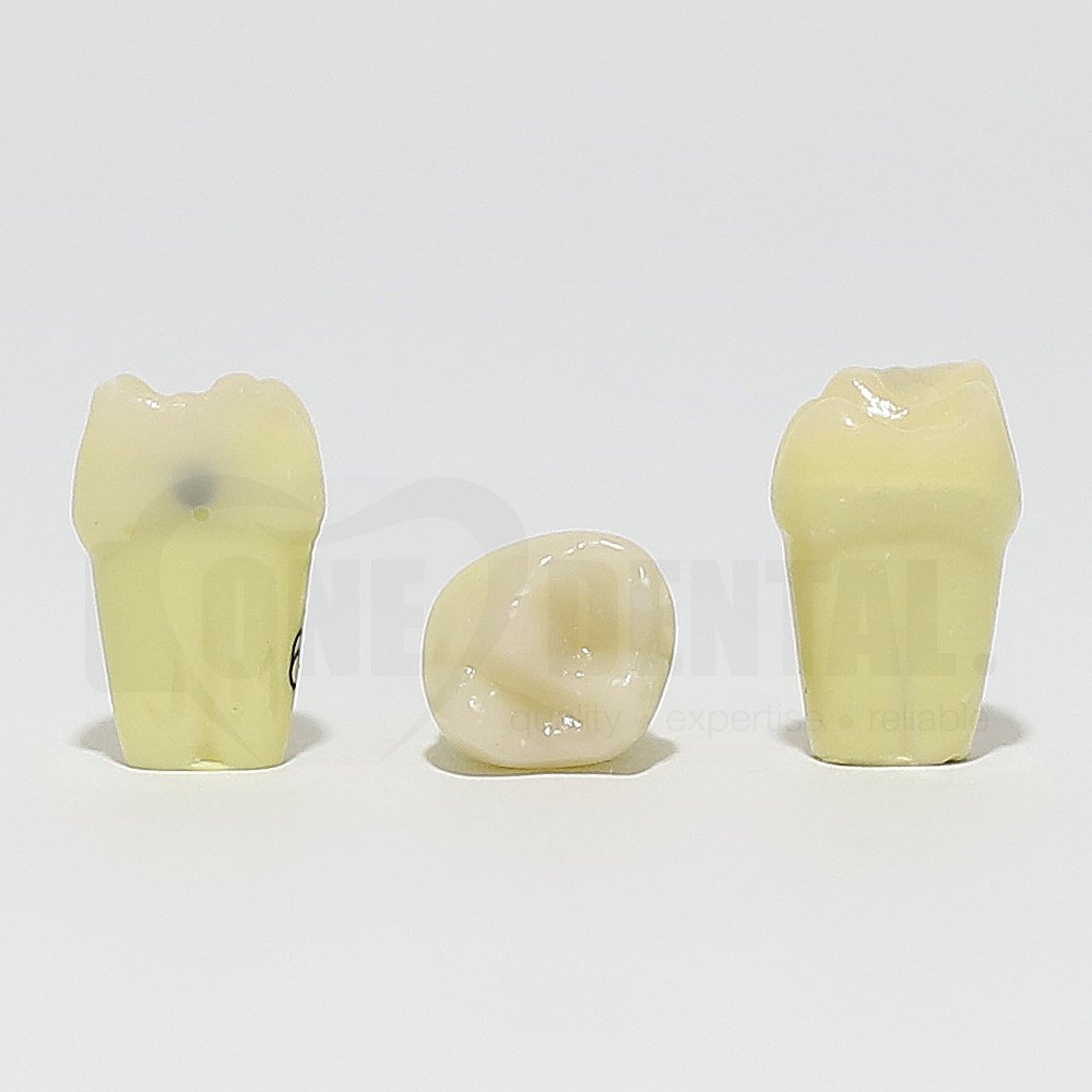 Caries Tooth 65 Mesial for 1974 Paedo Model