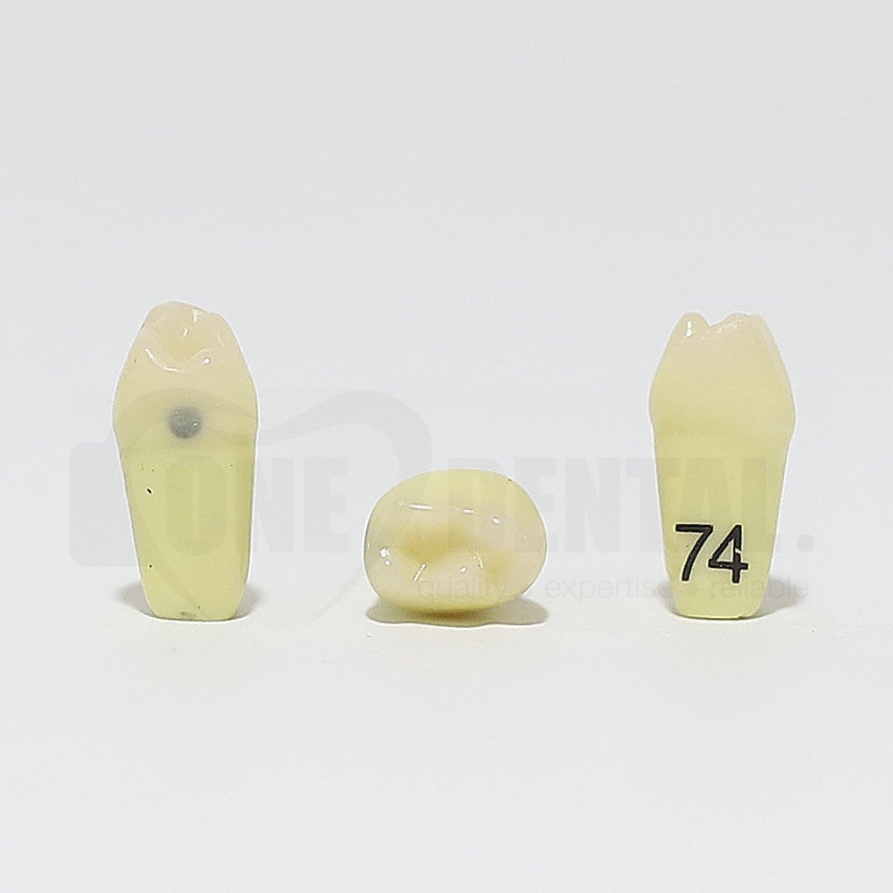 Caries Tooth 74 Distal for 1974 Paedo Model