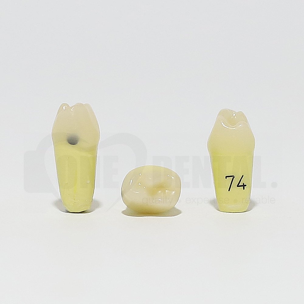 Caries Tooth 74 Mesial for 1974 Paedo Model