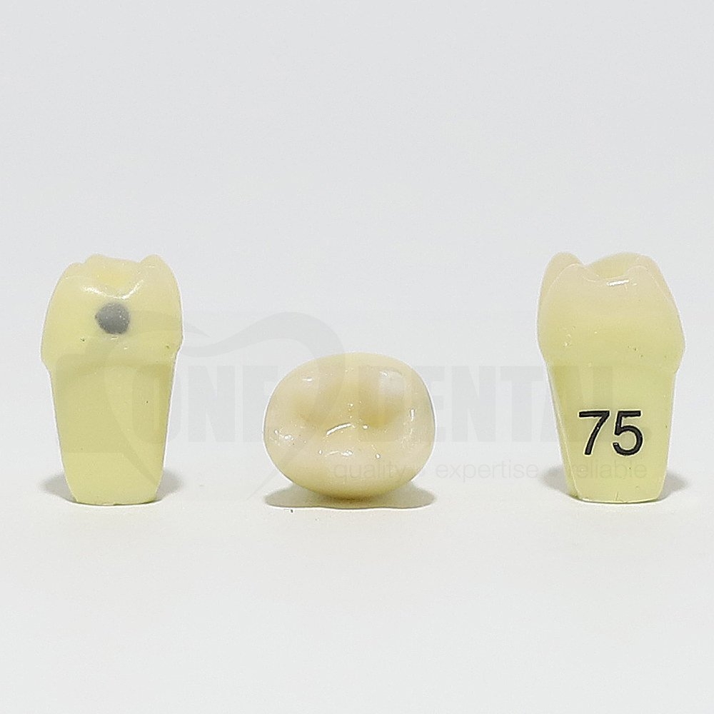 Caries Tooth 75 Distal for 1974 Paedo Model