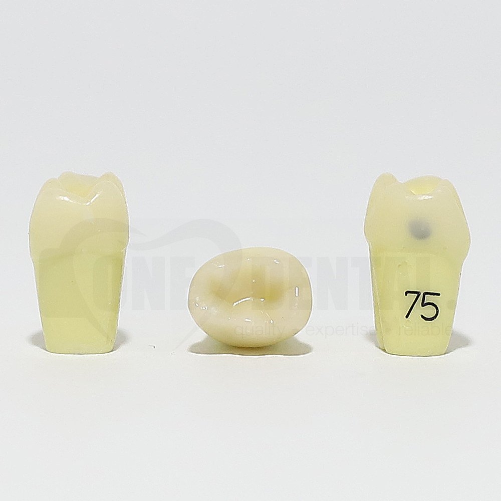 Caries Tooth 75 Mesial for 1974 Paedo Model