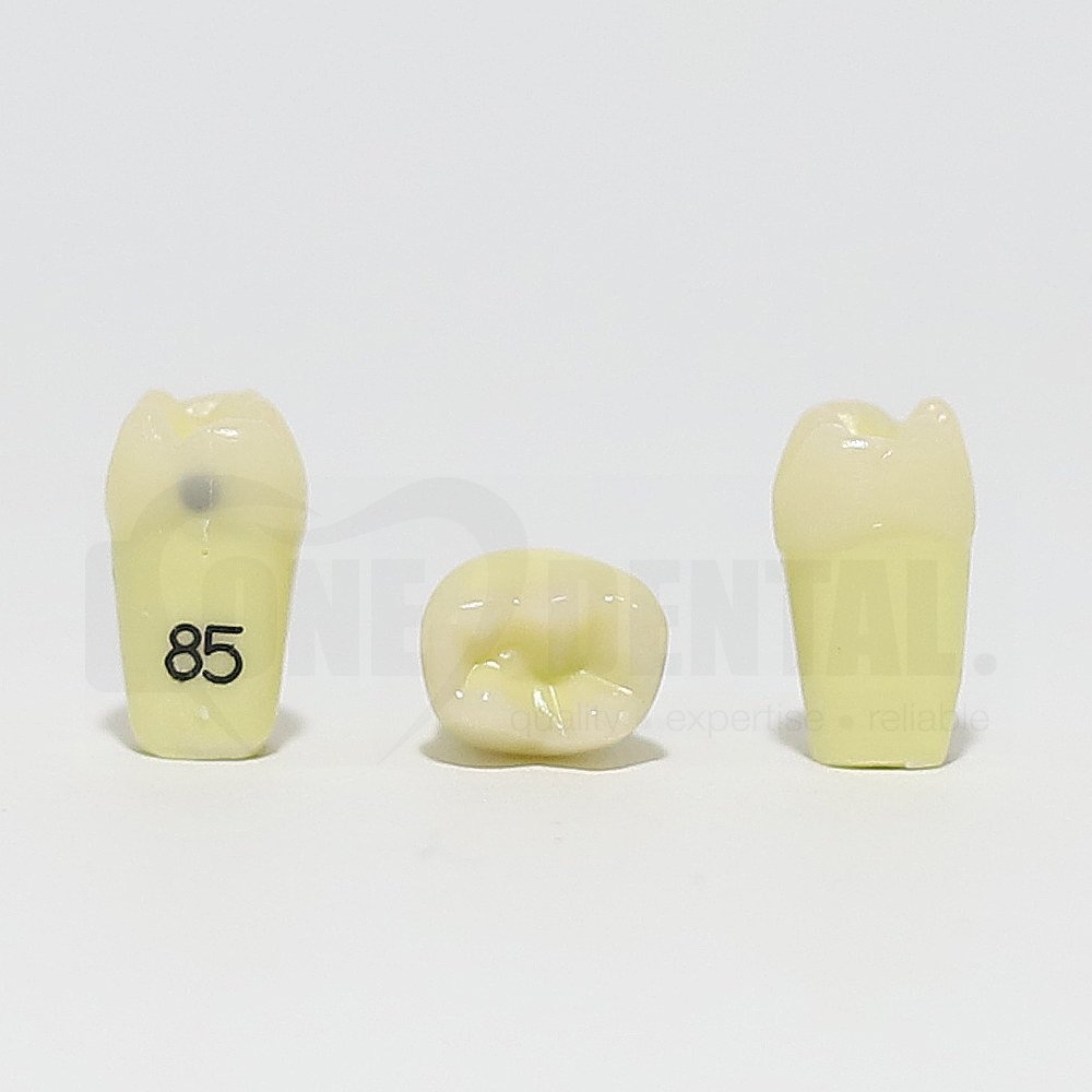 Caries Tooth 85 Distal for 1974 Paedo Model