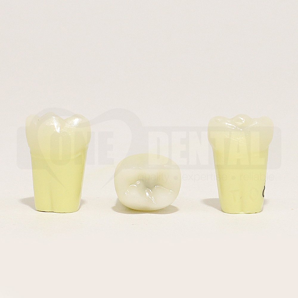 Caries Tooth 85 Occ for 1974 Paedo Model