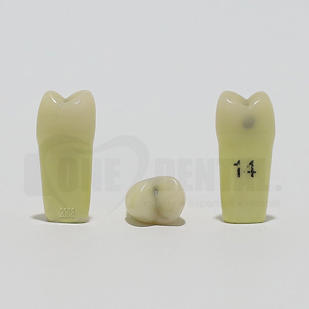 Caries Tooth 14DO for 2008 Adult Model