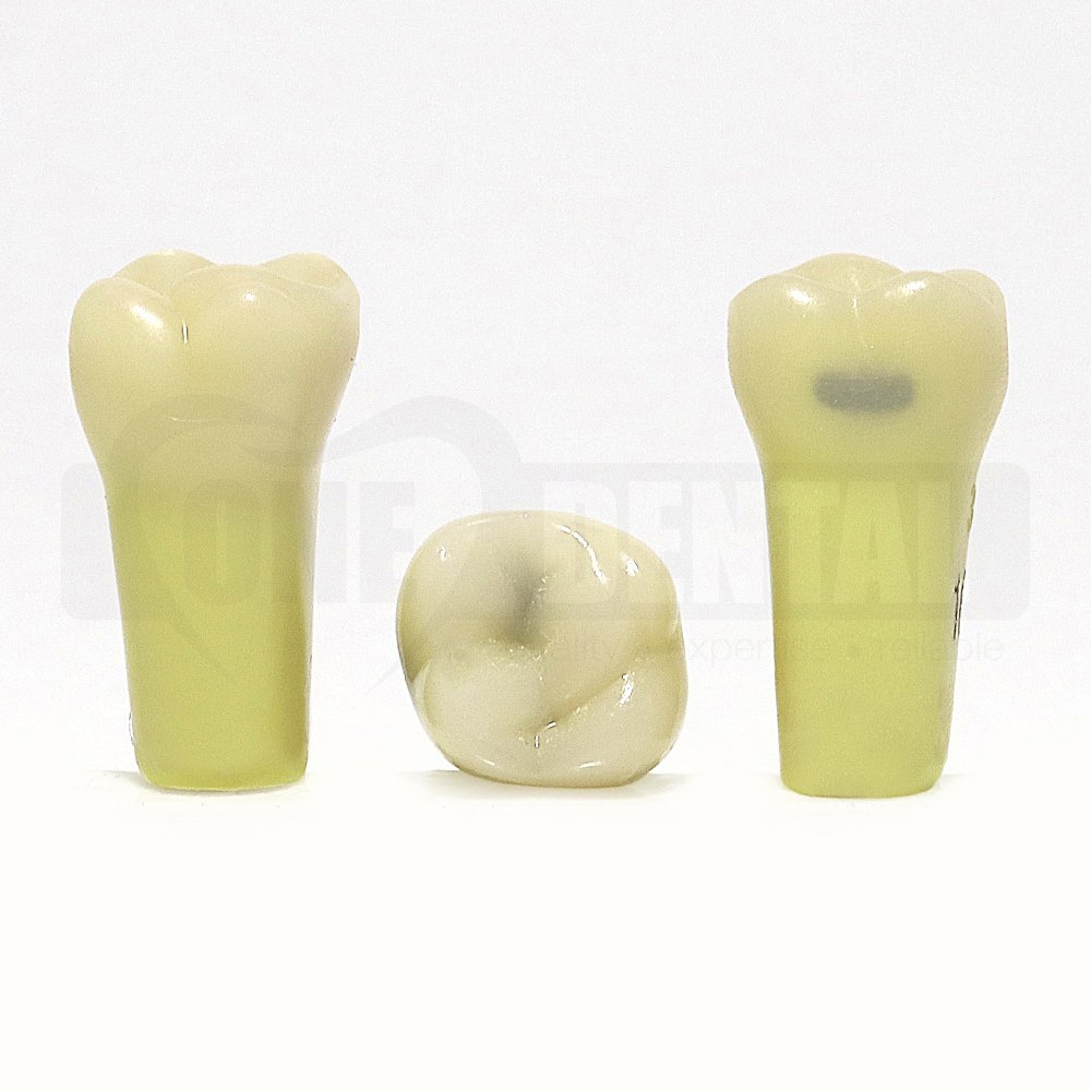 Caries Tooth 16 Buccal + 2 x Occlusal lesions DH for 2008 Adult Model
