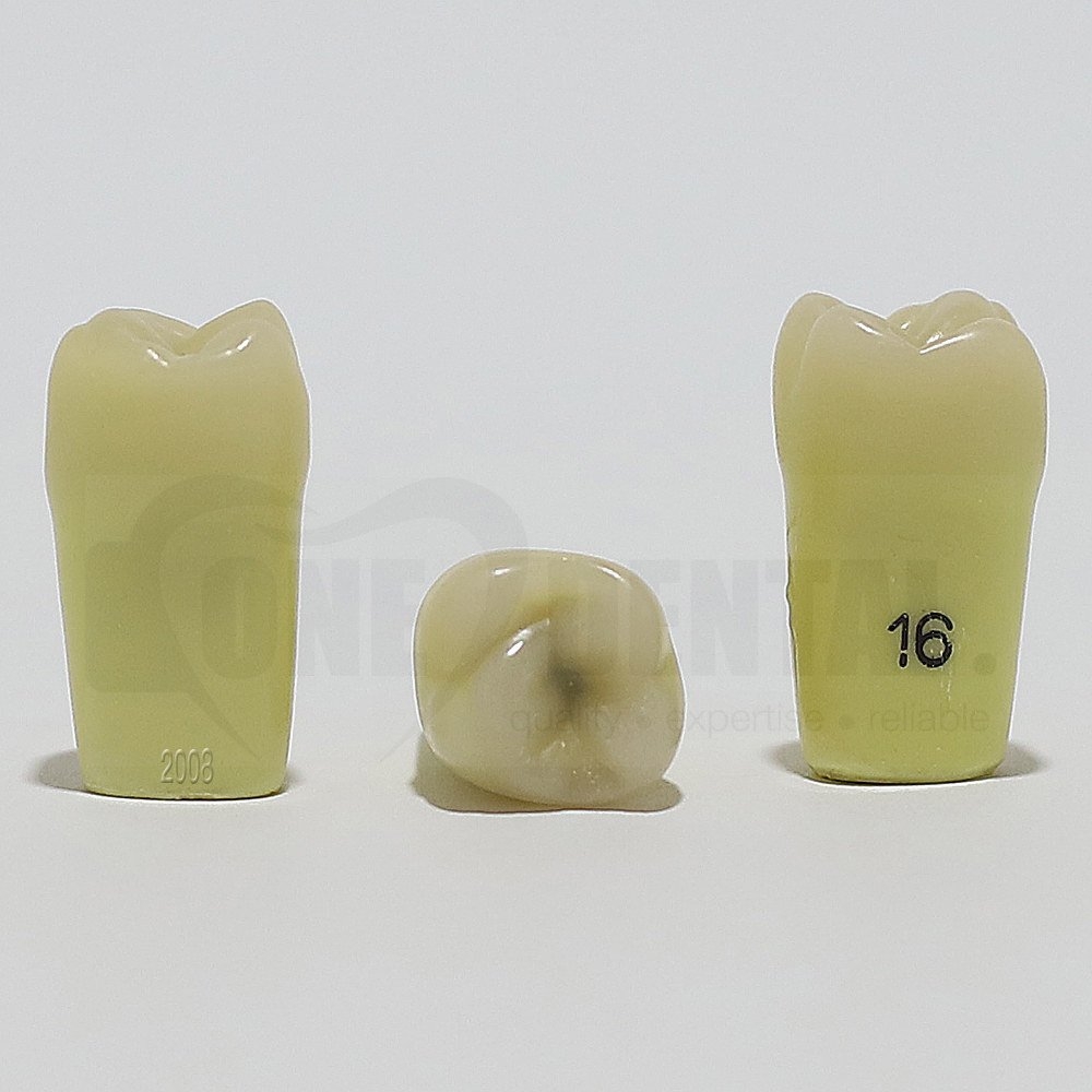 Caries Tooth 16Occ for 2008 Adult Model