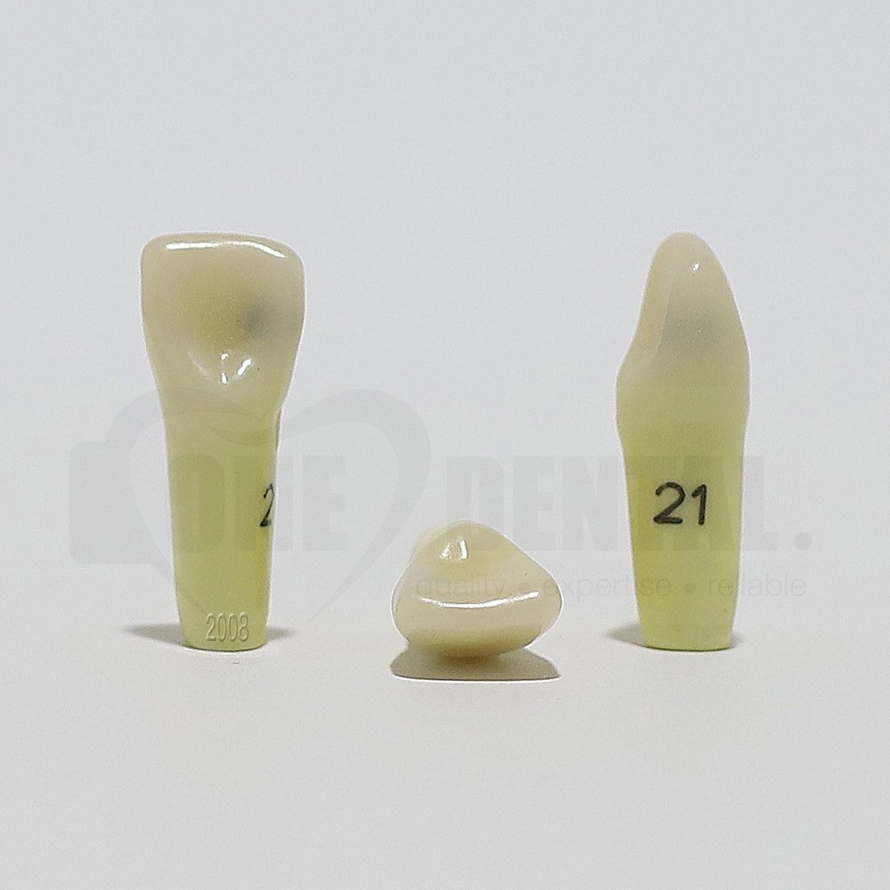 Caries Tooth 21 Dist Lingual for 2008 Adult Model