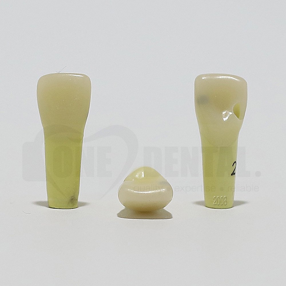 Caries Tooth 21 M + Distal Cavity for 2008 Adult Model