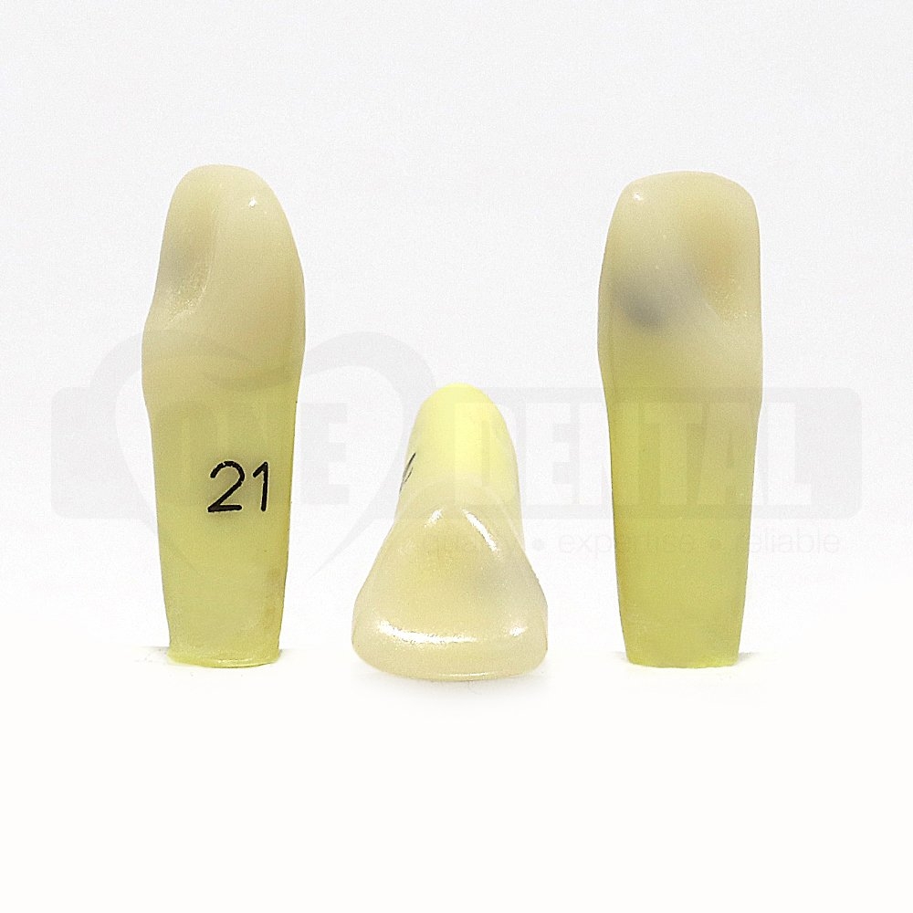 Caries Tooth 21 Mesial Palatal Lesion DH for 2008 Adult Model