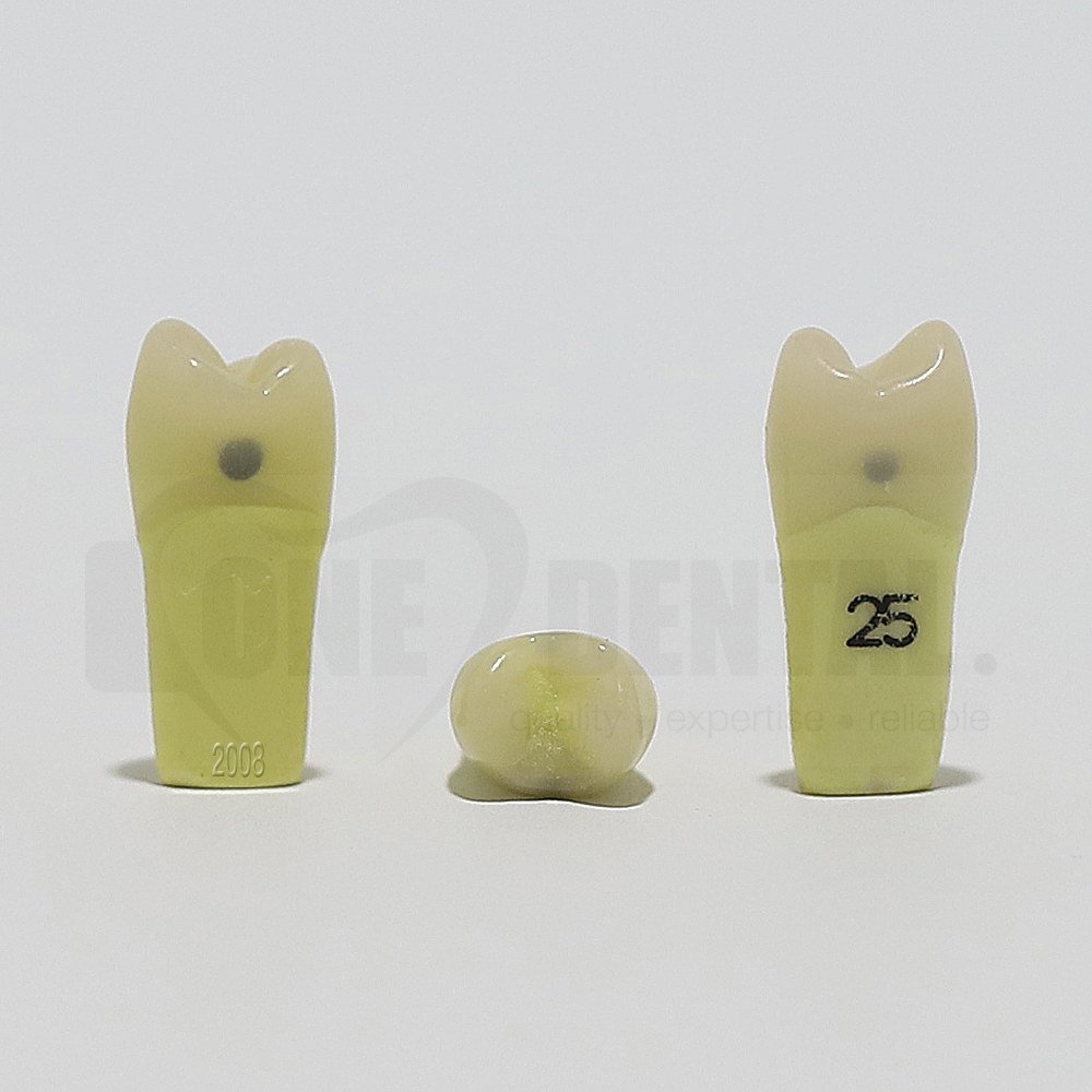 Caries Tooth 25MD for 2008 Adult Model