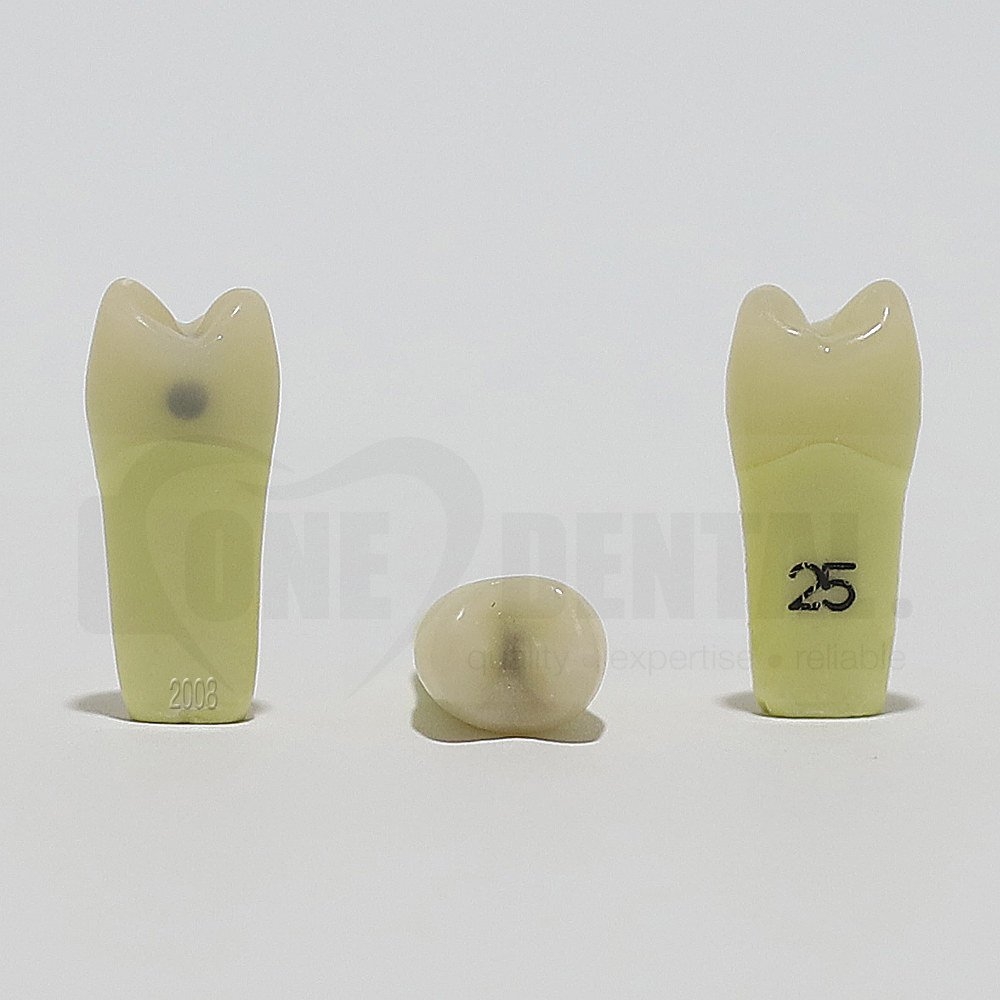 Caries Tooth 25M+O for 2008 Adult Model