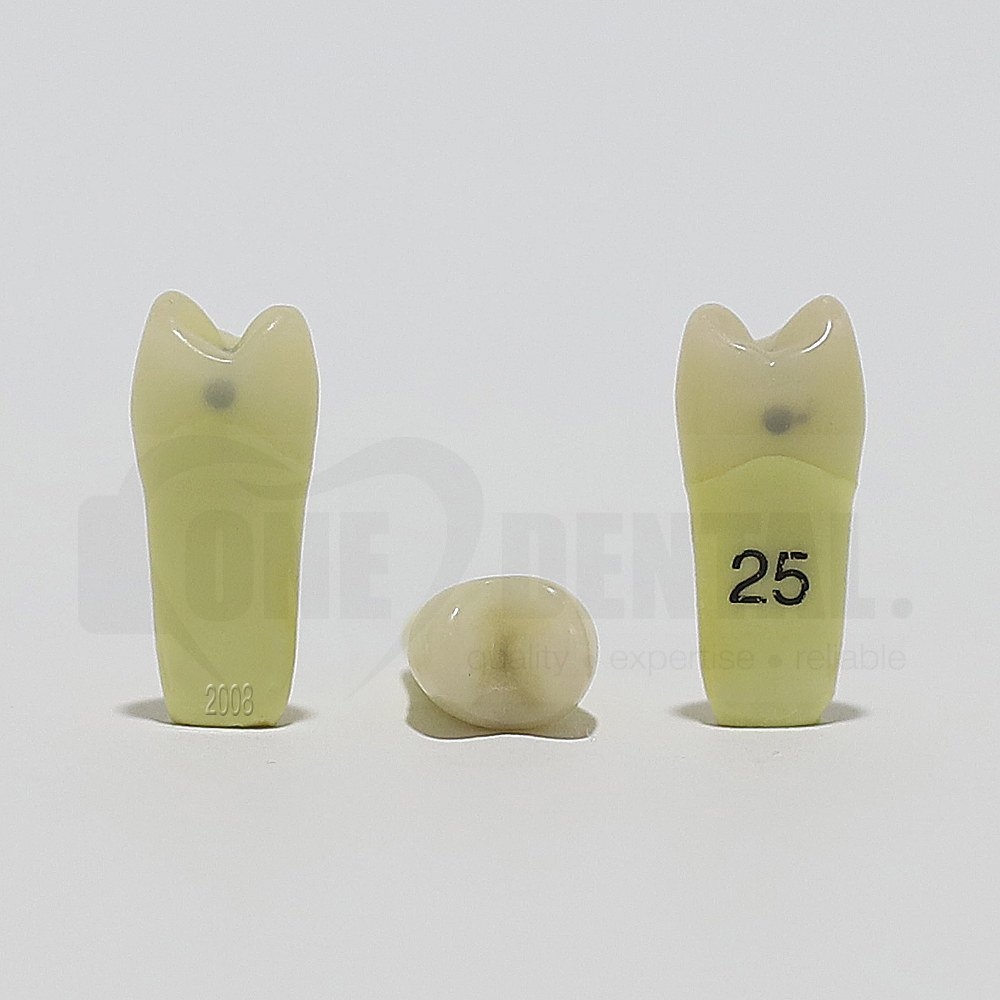 Caries Tooth 25 M+O+D for 2008 Adult Model