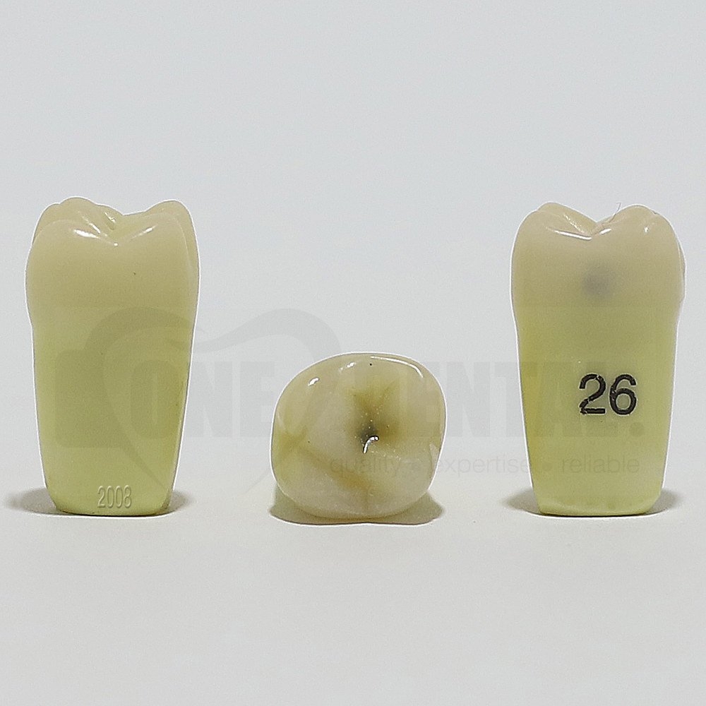 Caries Tooth 26M+O for 2008 Adult Model