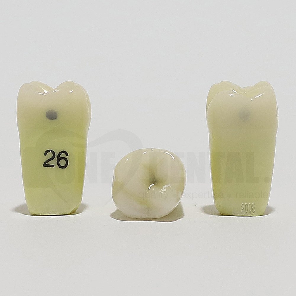 Caries Tooth 26M+O+D for 2008 Adult Model