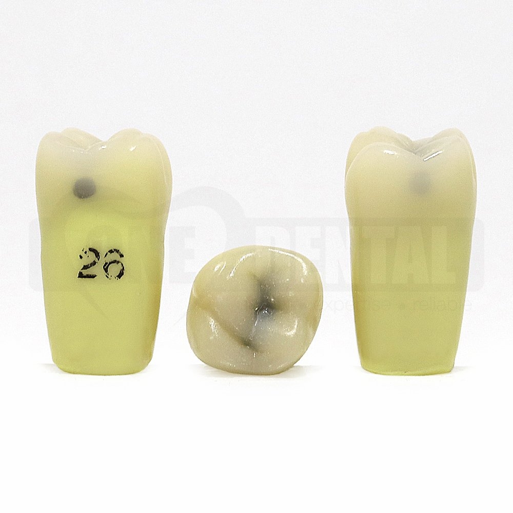Caries tooth 26MOD with caries undermining oblique ridge DH for 2008 Adult Model