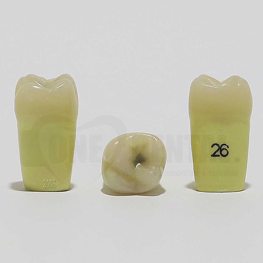 Caries Tooth 26 Occ for 2008 Adult Model