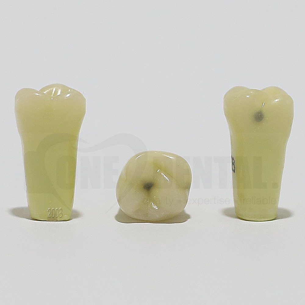 Caries Tooth 26O+L for 2008 Adult Model