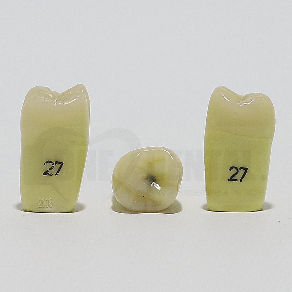 Caries Tooth 27Occ for 2008 Adult Model