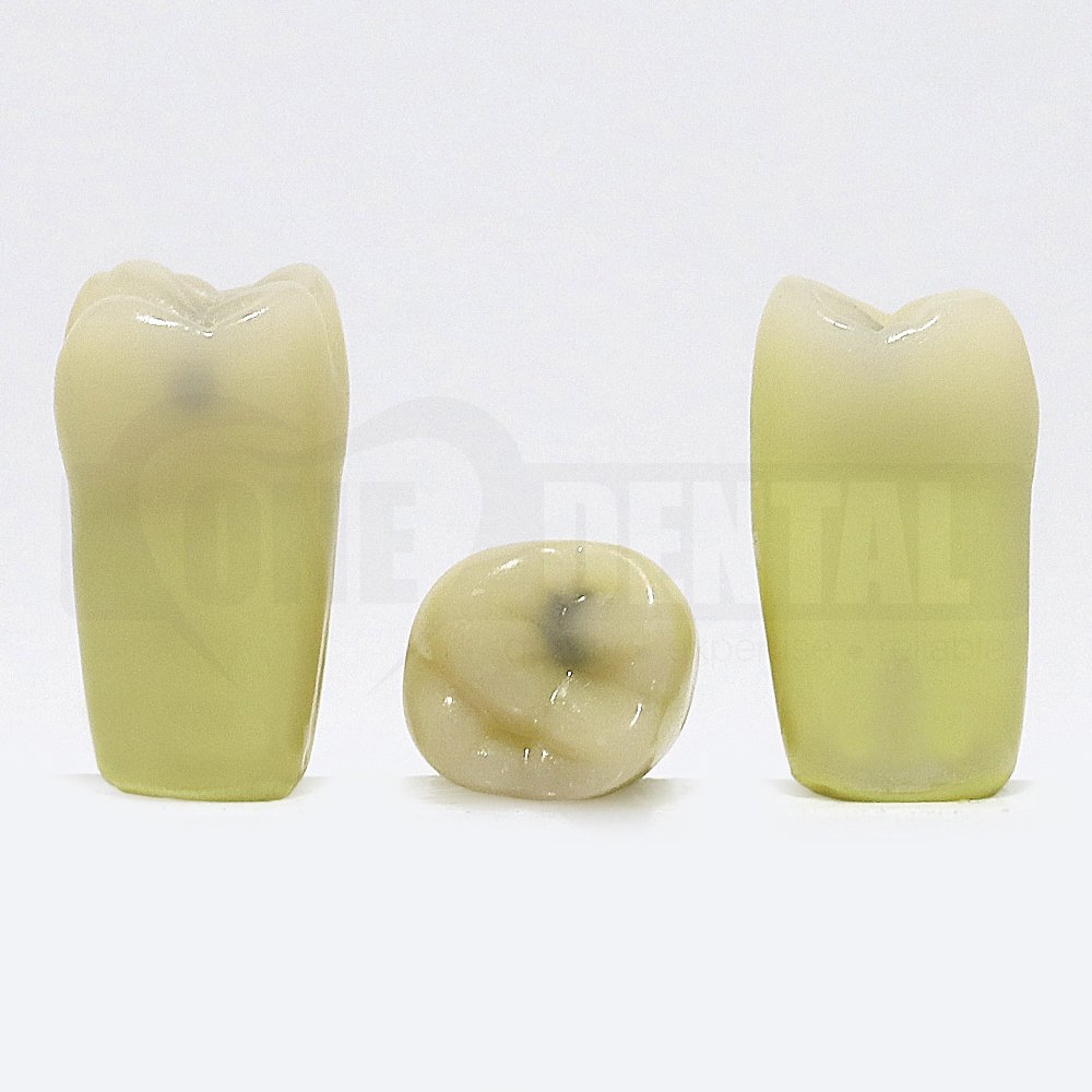 Caries Tooth 27 Occ DH for 2008 Adult Model