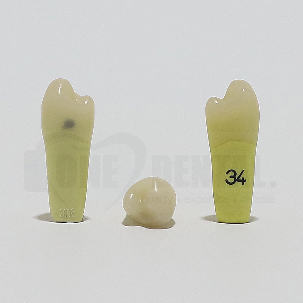 Caries Tooth 34 Distal for 2008 Adult Model