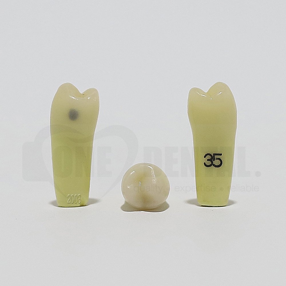Caries Tooth 35 Distal for 2008 Adult Model