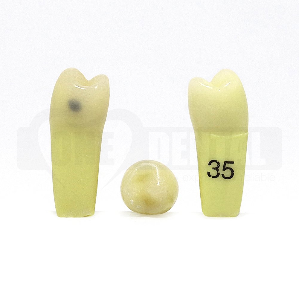Caries Tooth 35D+O DH for 2008 Adult Model