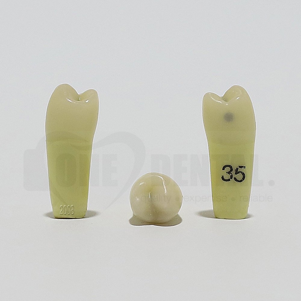 Caries Tooth 35M+O for 2008 Adult Model