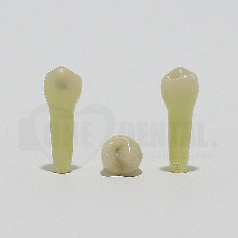 Caries Tooth 35O+B for 2008 Adult Model