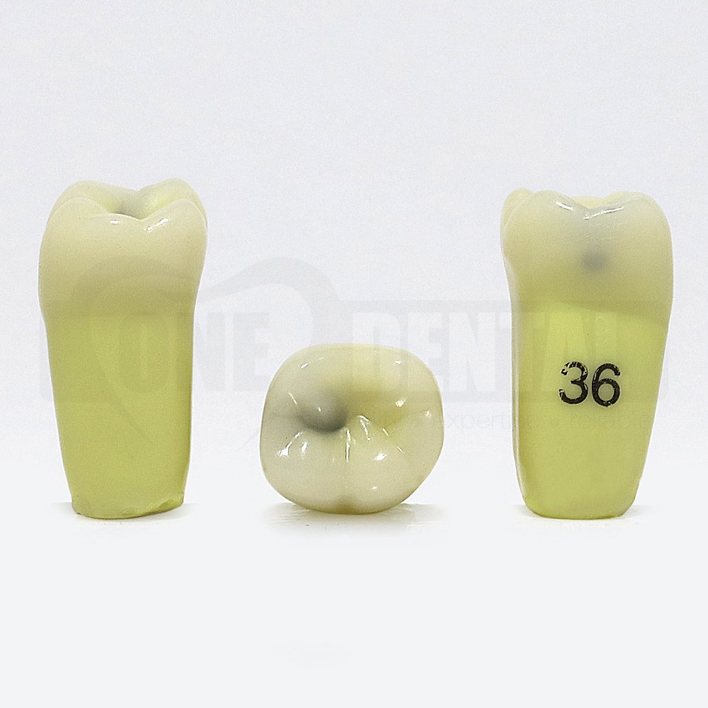 Caries Tooth 36MO DH for 2008 Adult Model