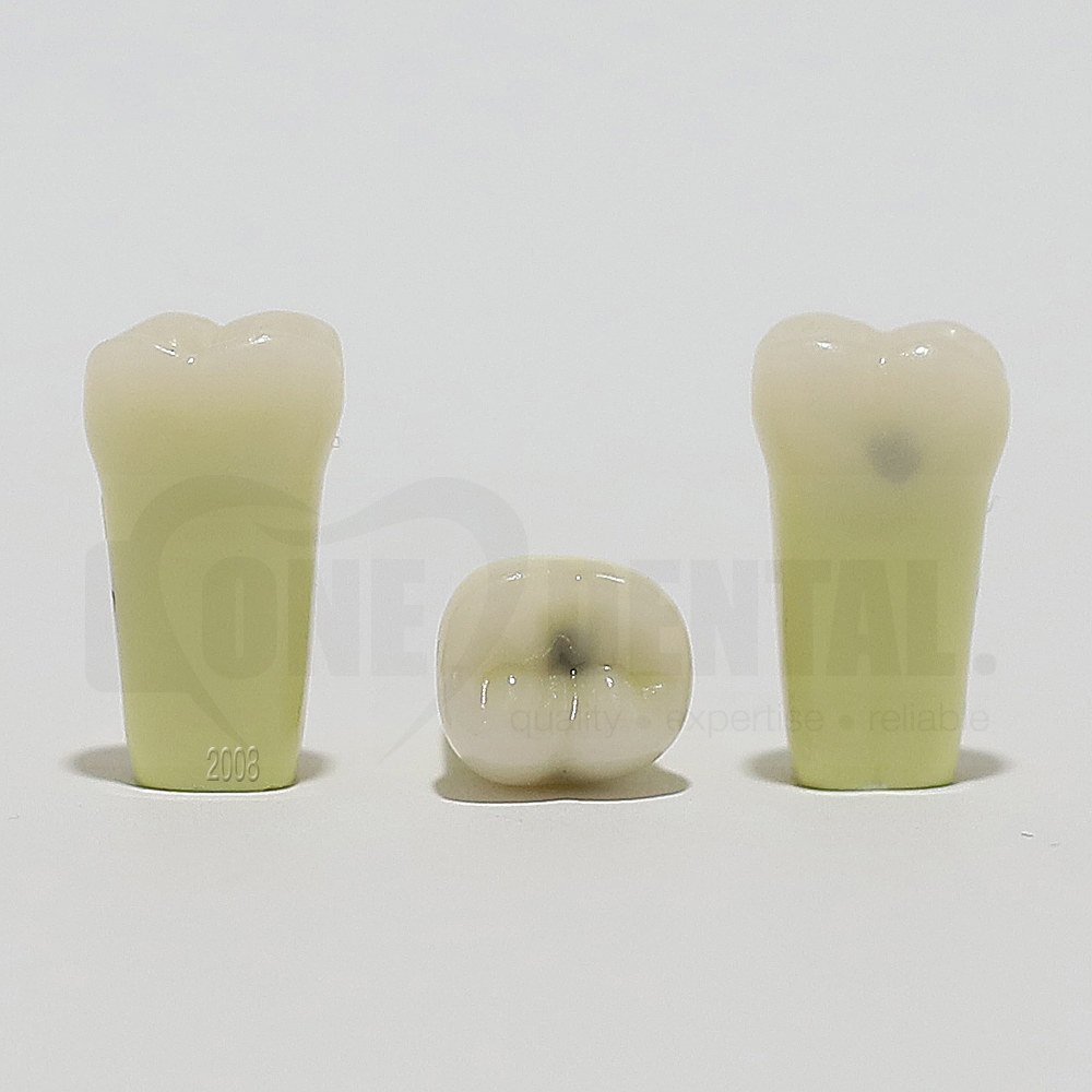 Caries Tooth 37O+B for 2008 Adult Model