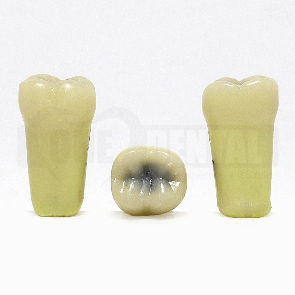 Caries Tooth 37 Occlusal Large lesion DH for 2008 Adult Model