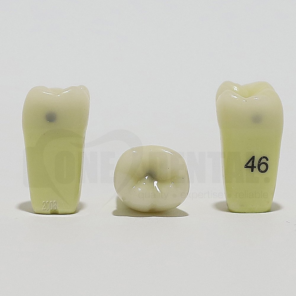 Caries Tooth 46M+O+D for 2008 Adult Model