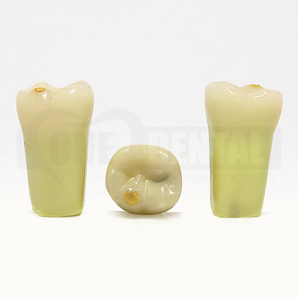 Caries Tooth 46Occ x 2 Includes Open Cuspal Caries Lesions DH for 2008 Adult Mod