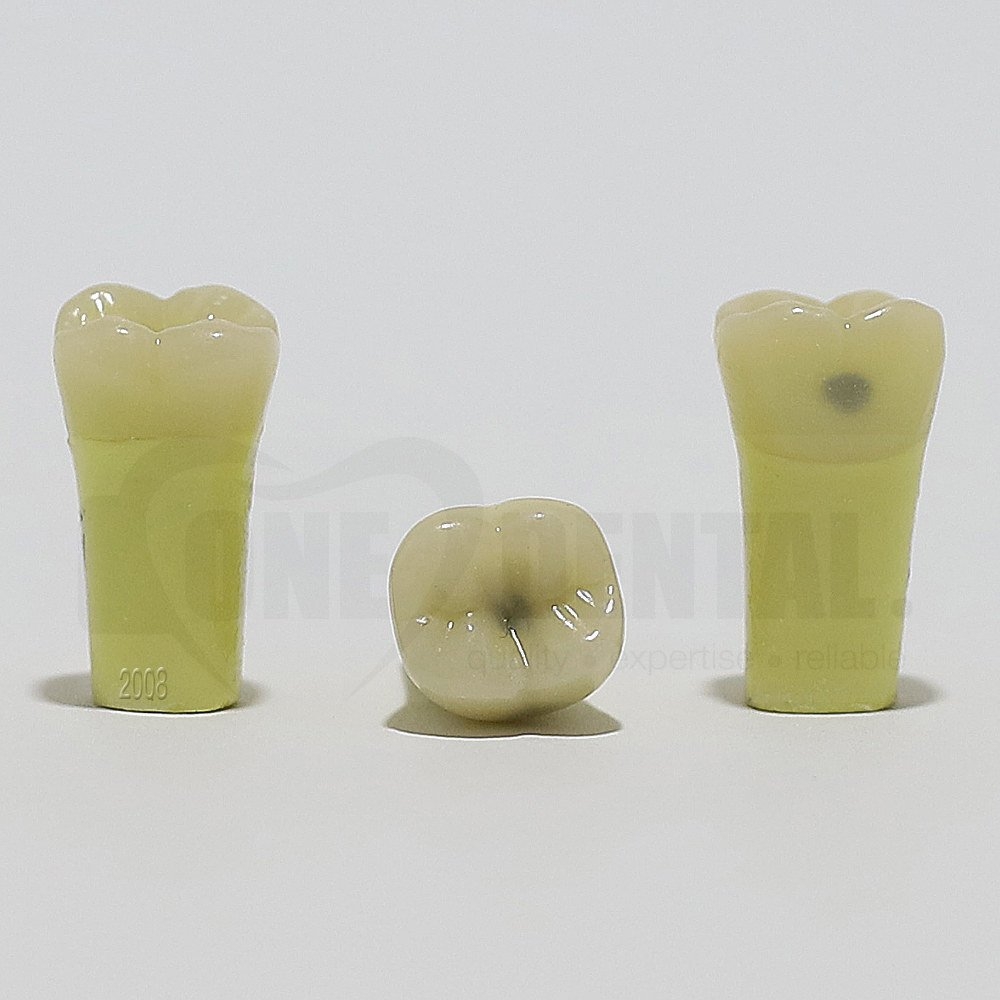Caries Tooth 47O+B for 2008 Adult Model