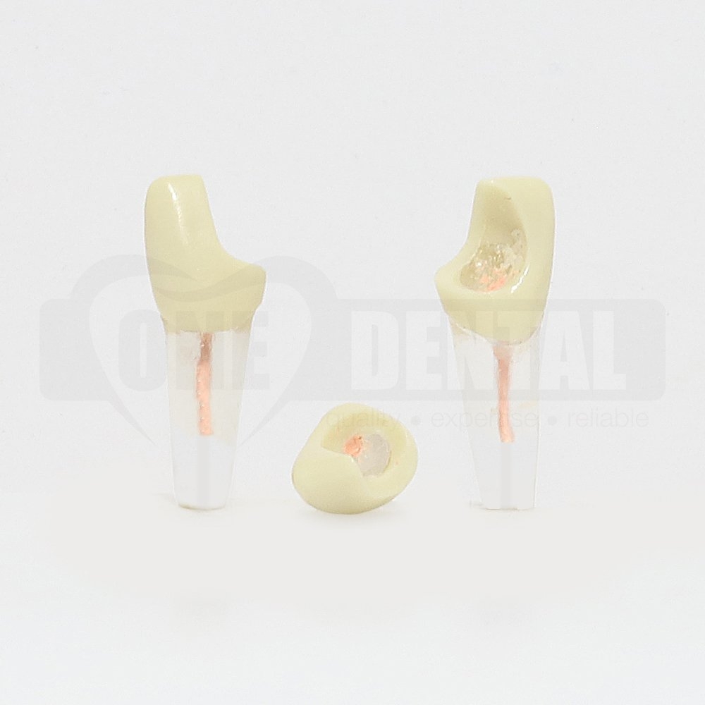 Tooth 11 Endo Gutta Percha Filled and Distal Cavity for 2008 Adult Model