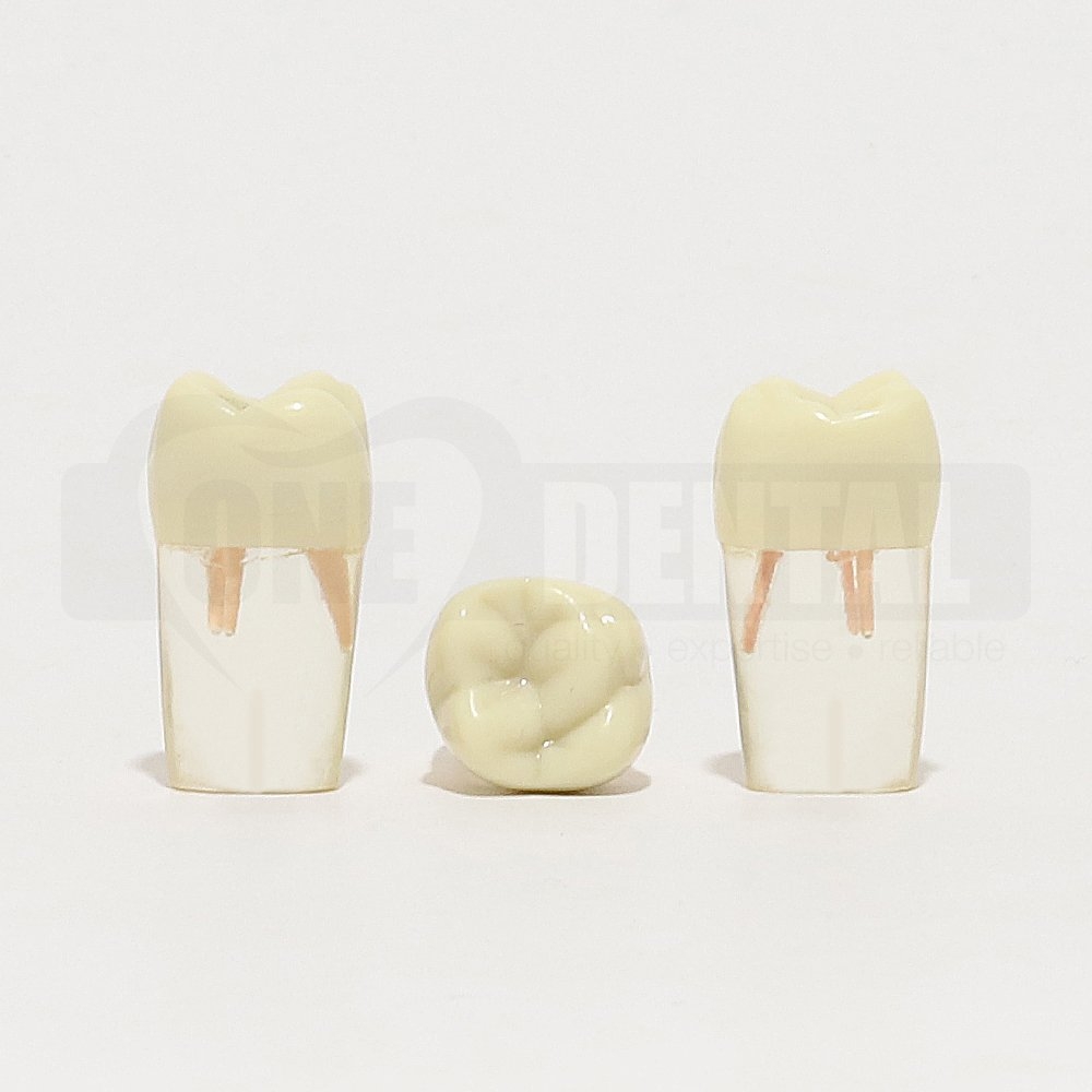Tooth 16 Endo Gutta Percha Filled for 2008 Adult Model