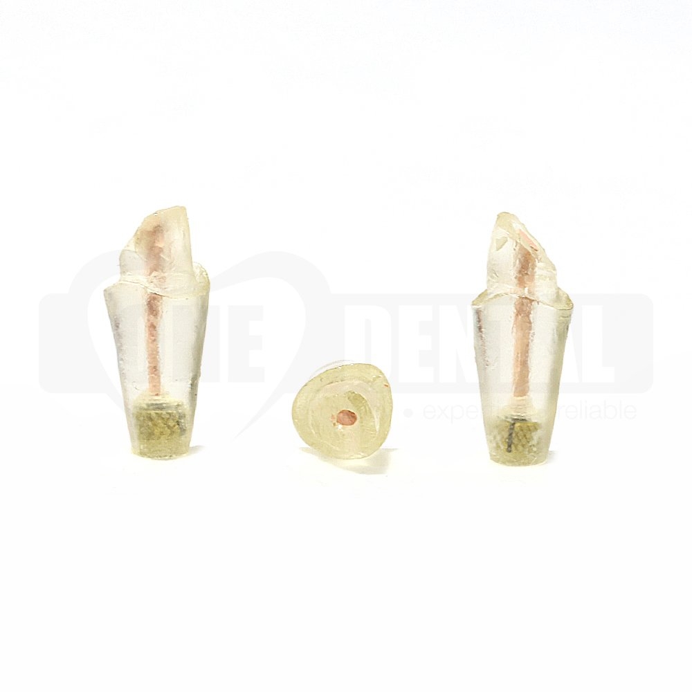 Tooth 21 Endo Gutta Percha Filled with Full Crown Prep for 2008 Adult Model