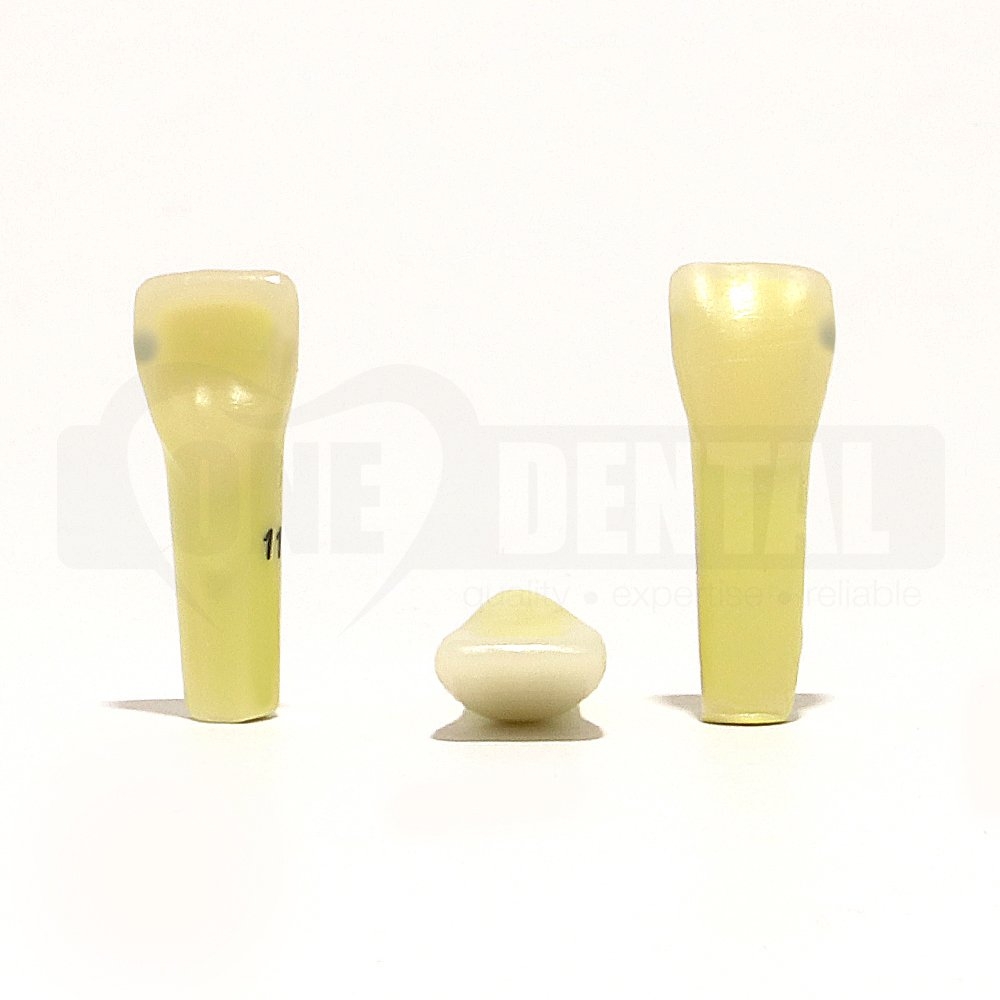 Caries tooth 11D for 2010 Adult Model