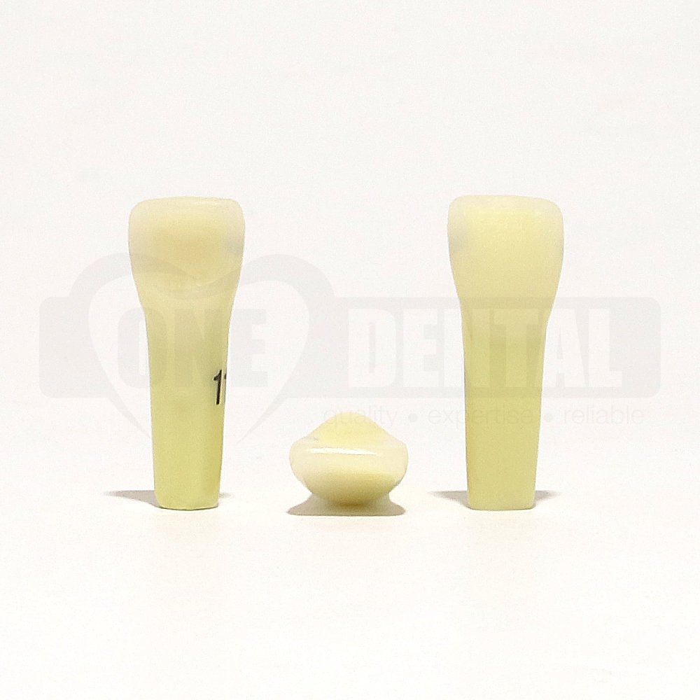 Caries tooth 11MD for 2010 Adult Model