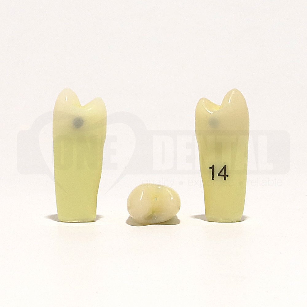 Caries Tooth 14 MD for 2010 Adult Model
