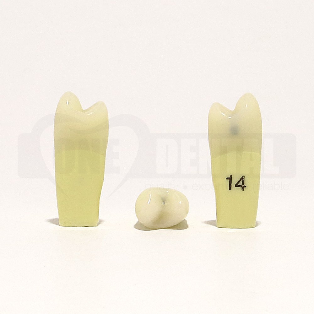 Caries Tooth 14 MO for 2010 Adult Model