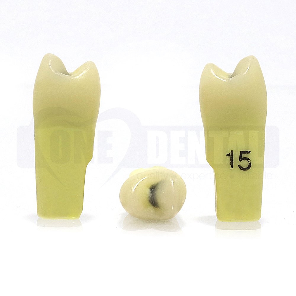 Caries Tooth 15 Occ GW Extended Adult Scope for 2010 Adult Model