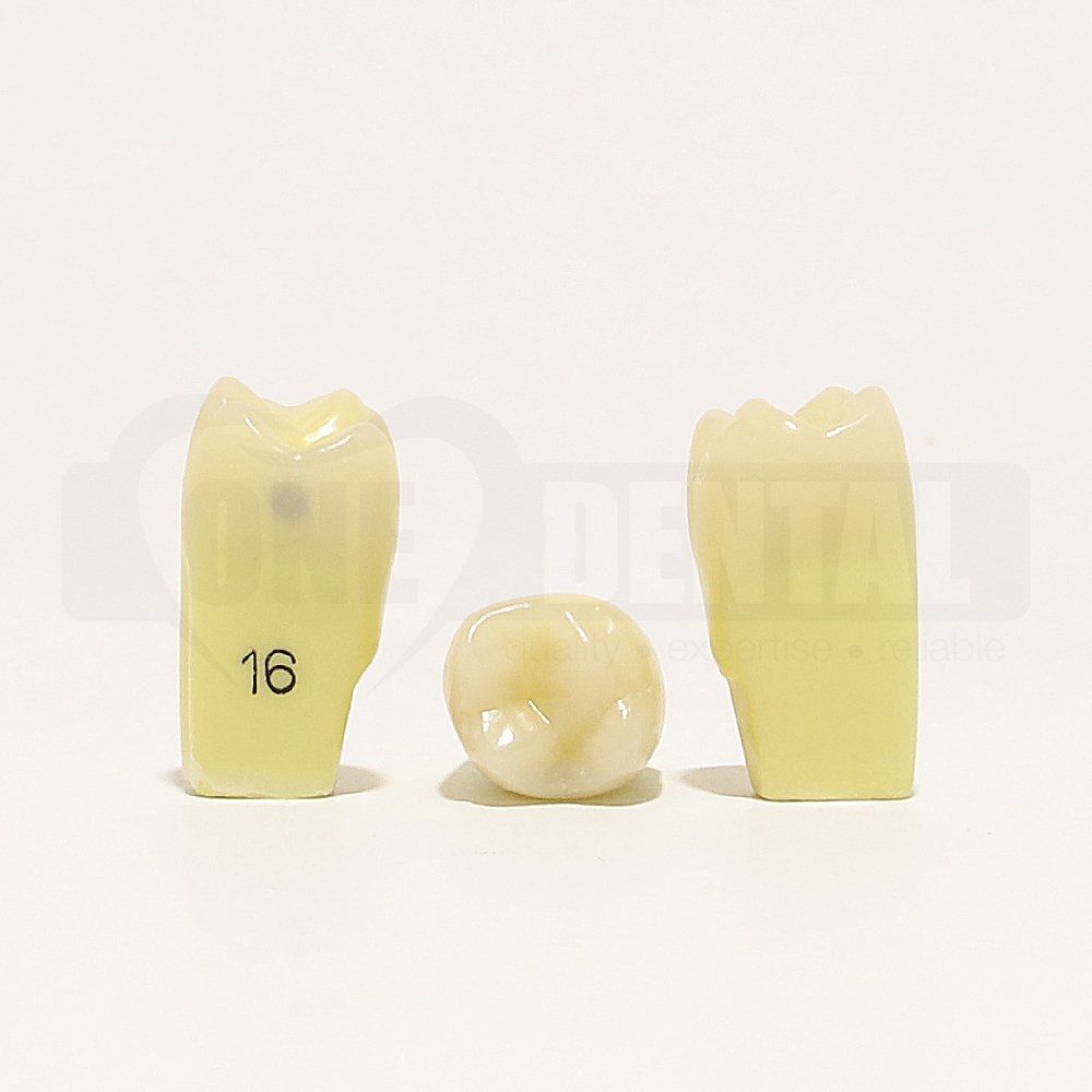 Caries Tooth 16 Distal for 2010 Adult Model
